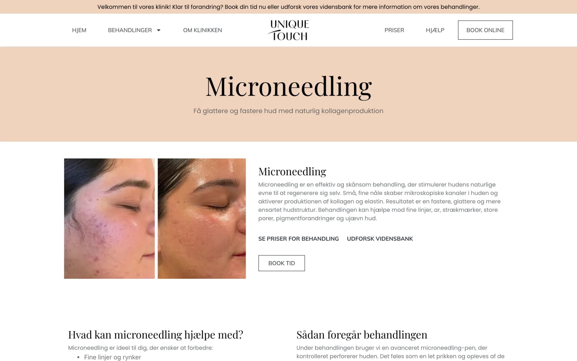Siden om microneedling på utouch.dk med før og efter billeder